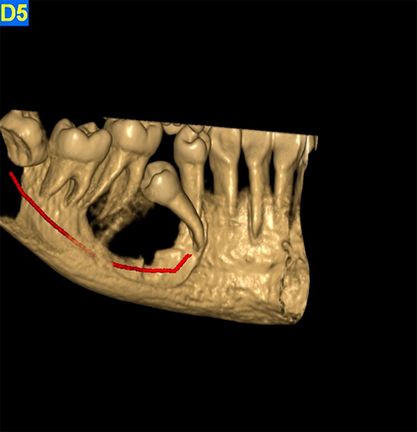 Centro Radiológico Dental San Diego radiografía maxilar 3d